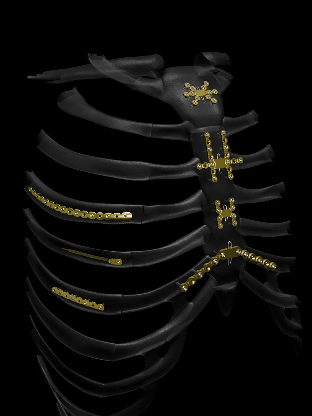 Rib and Sternum Plating System | NX Medical