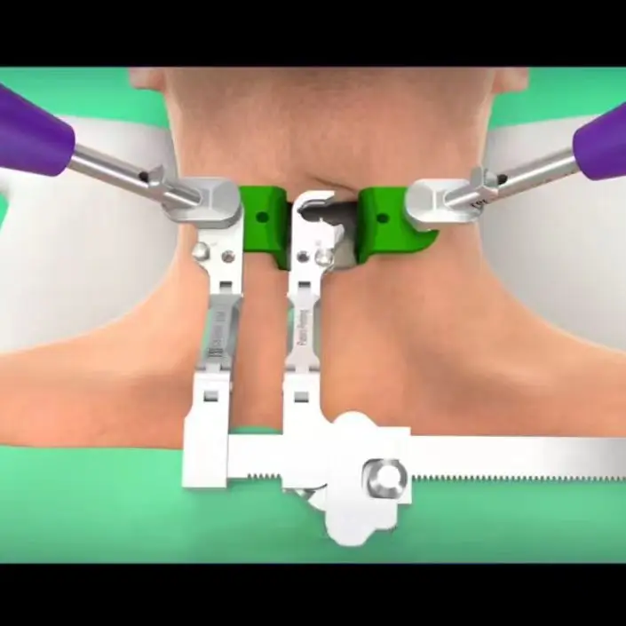 Cervical Retractor System for ACDF Surgery